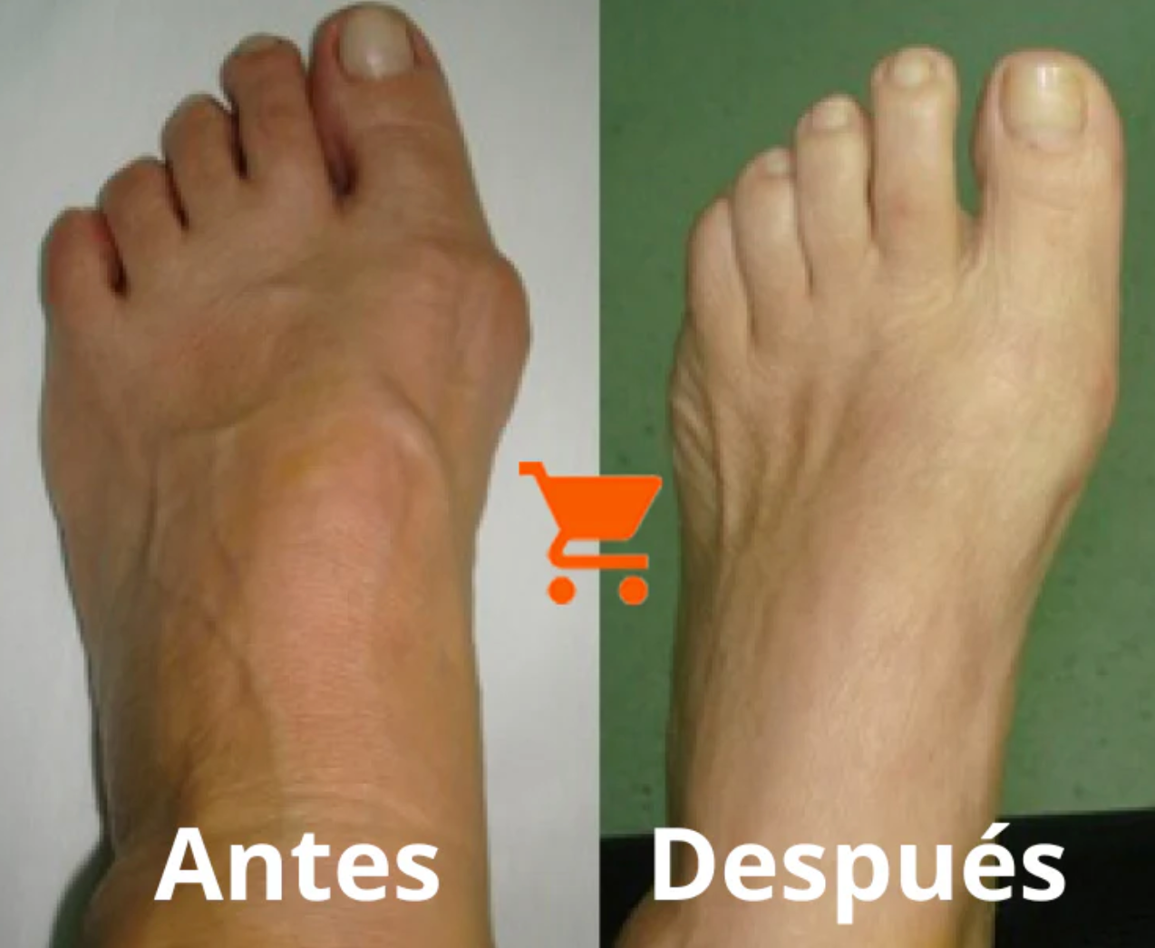Corrector de Juanetes Bonex Bunion Fix™