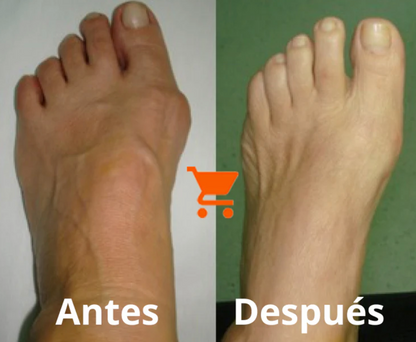 Corrector de Juanetes  Bonex Bunion Fix™